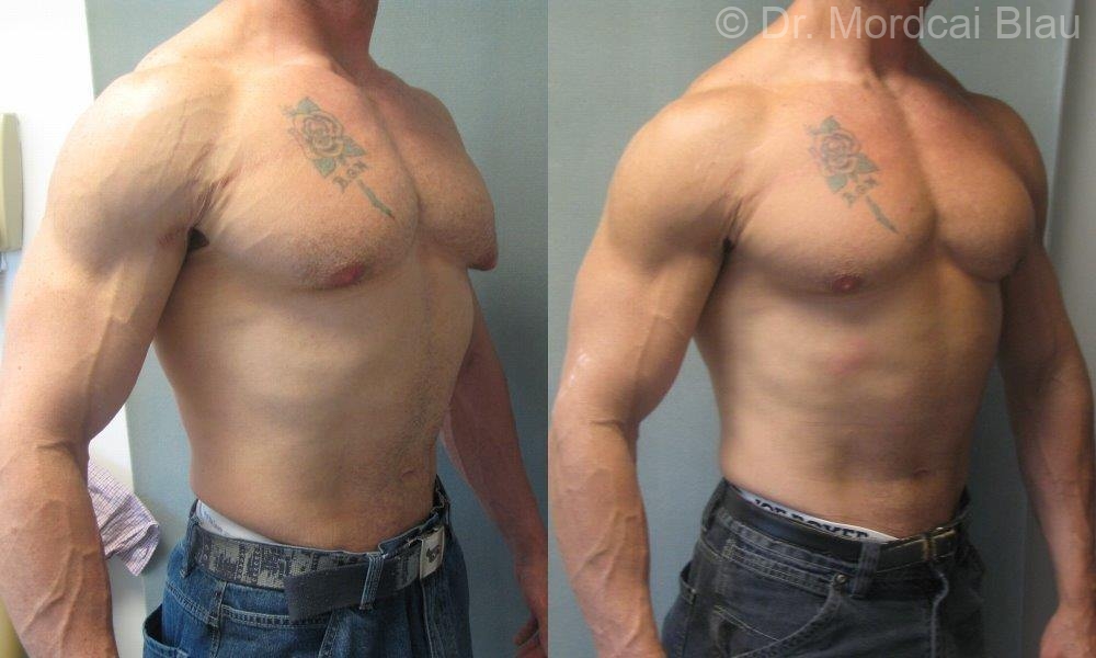 Bodybuilder Gynecomastia Before And After Photos Gynecomastia Usa