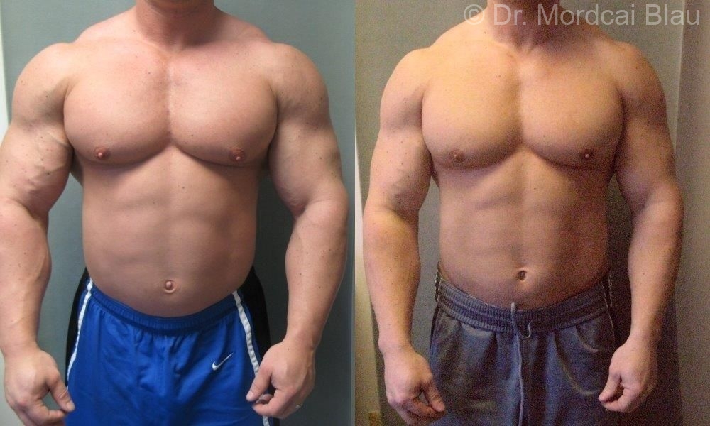 Professional Bodybuilders Gynecomastia Surgery Before And After