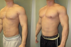 Bodybuilder Gynecomastia - Before And After Photos ⋆ Gynecomastia USA