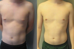 Nipple-Reduct-6982-10