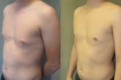 Nipple-Reduct-6982-11