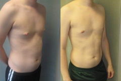 Nipple-Reduct-6982-13