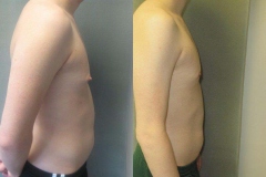 Nipple-Reduct-6982-14