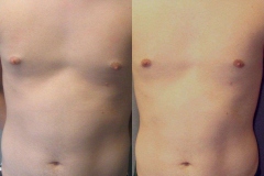 Nipple-Reduct-6982-15