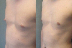 Nipple-Reduct-6982-16