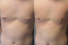 Nipple-Reduct-6982-18