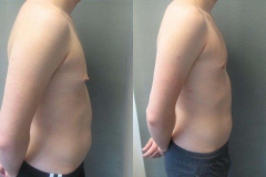 Nipple-Reduct-6982-5