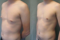 Nipple-Reduct-6982-6