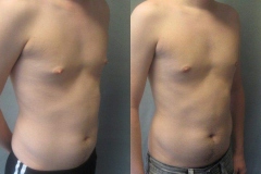 Nipple-Reduct-6982-7