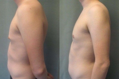 Nipple-Reduct-6982-9