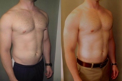 Nipple-Reduct-7371-2