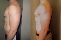 Nipple-Reduct-7371-3