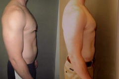 Nipple-Reduct-7371-4