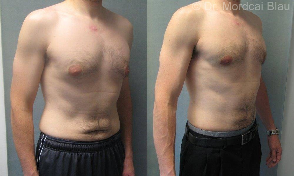 6 Day Post gynecomastia surgery workout for Weight Loss