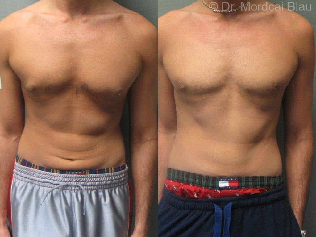 15 Minute When can i workout after gynecomastia surgery for Burn Fat fast