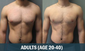 Adult Gynecomastia