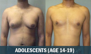 Adolescent Gynecomastia