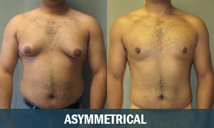 Asymmetrical Gynecomastia