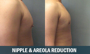 Nipple Reduction