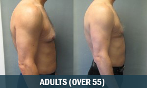 Adult Gynecomastia