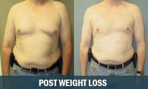 Post Weight Loss