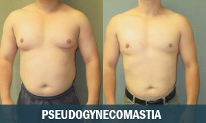 Pseudogynecomastia