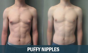 Puffy Nipples