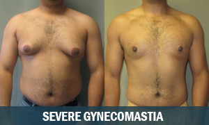 Severe Gynecomastia