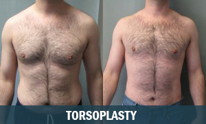 Torsoplasty