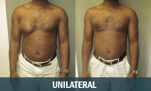 Unilateral Gynecomastia